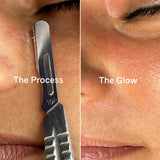 Dermaplaning